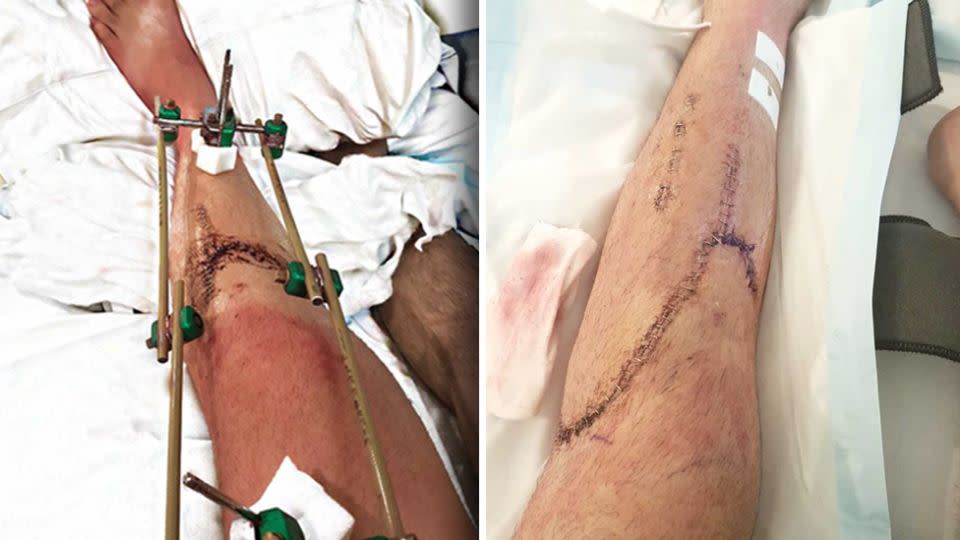 The young dad has undergone several rounds of surgery after his leg was crushed. Source: Supplied