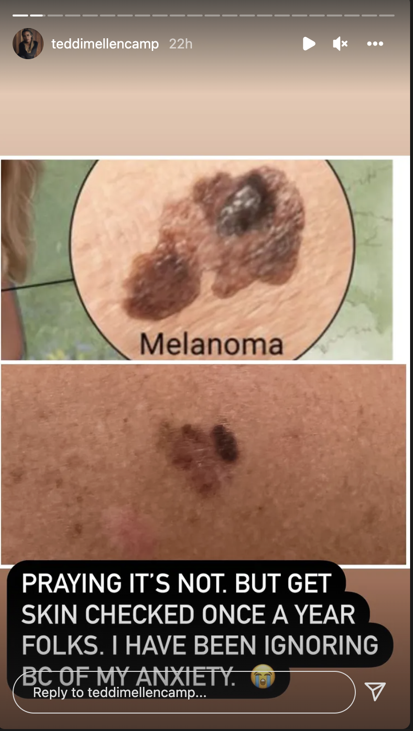 Teddi Mellencamp also shared a photo of her moles in comparison to Melanoma.