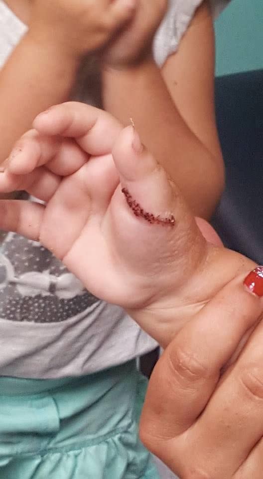 Hunter's stabilising tendon was severed and he had blood squirting from his thumb. Photo: Tiahnee Kero/Supplied