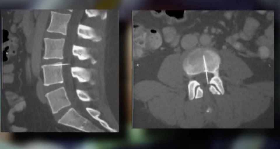 A CT scan carried out by doctors in Texas showed Amy she had a needle lodged in her back. Photo: First Coast News