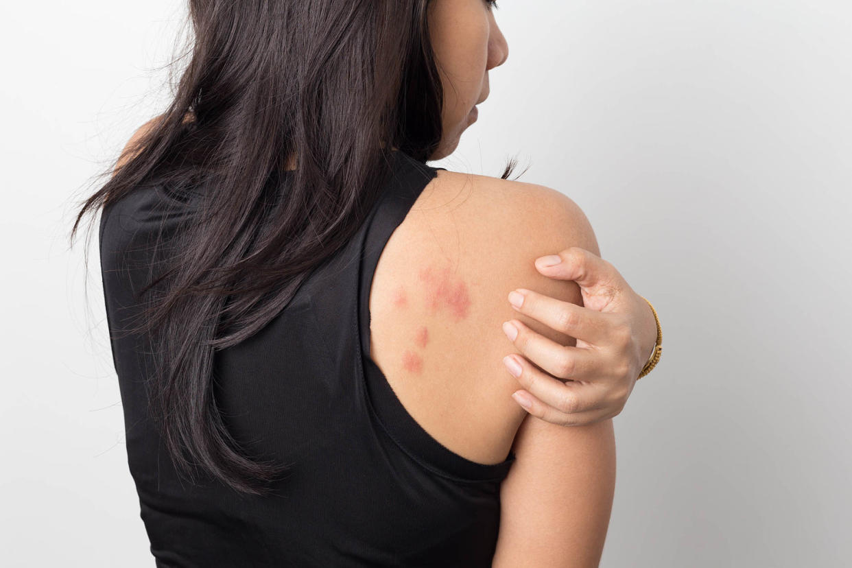 woman with hives (Getty Images)