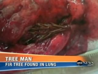 a piece of tree in someone's lung