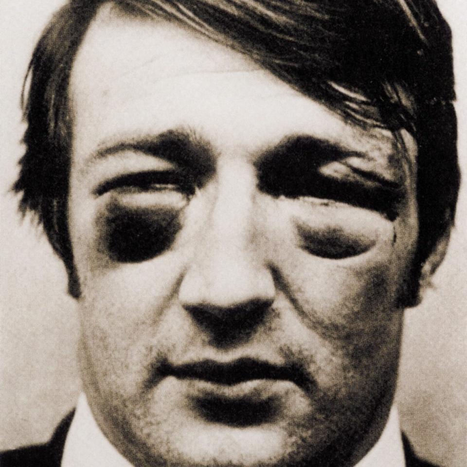 Carmichael suffered five cheek fractures in one match against New Zealand in 1971 - The subsequent photograph of his facial scars is one of rugby’s most iconic if grizzly images