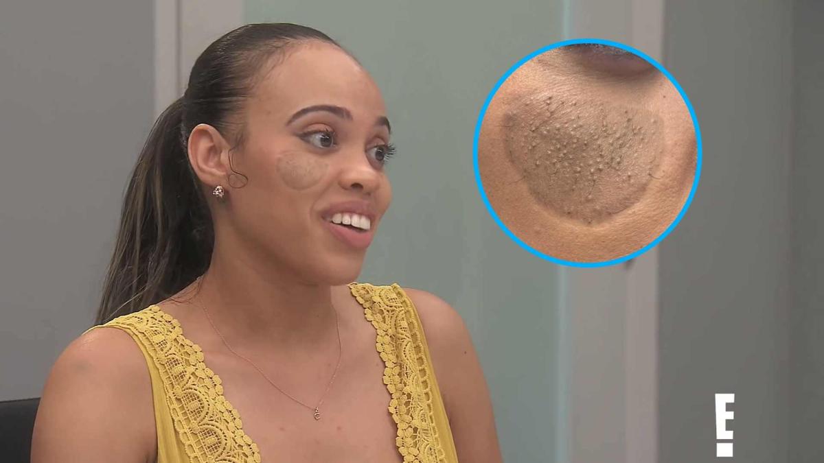 'Botched' Doctors Fix Dog Bite Victim's Unusual Skin Graft, 'Pubic Hair