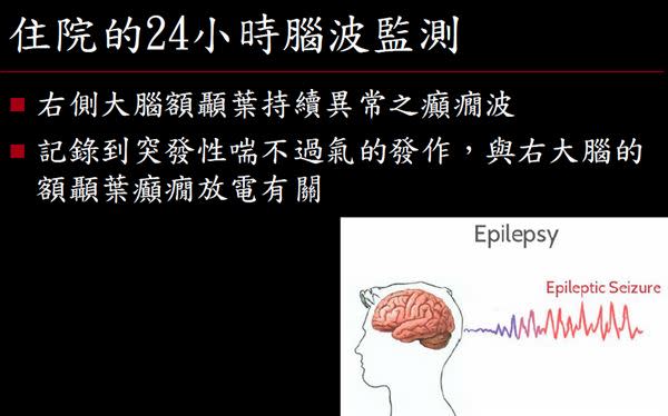 癲癇初期診斷需透過住院長時間影像腦波監測判定。(圖片提供／成大醫院)