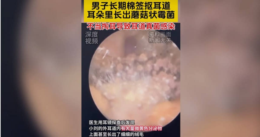 黑龍江哈爾濱一男子因長期用棉簽摳耳道導致耳朵真菌感染，耳道長滿蘑菇狀分泌物。（圖／翻攝深度視頻）