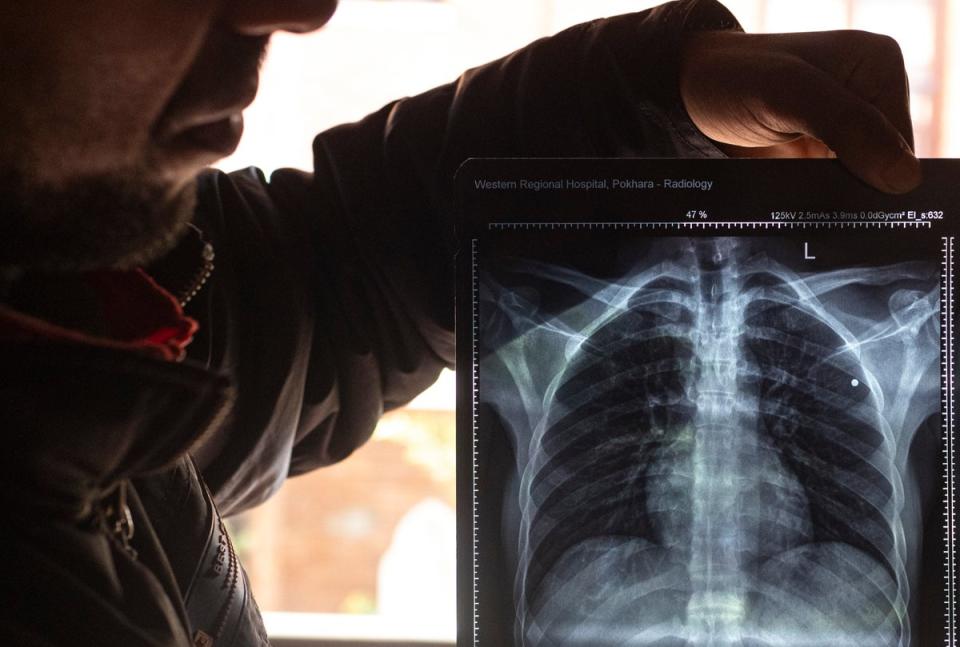 Krishna Sharma (named changed) displays his X-ray plate, revealing ‘grenade fragments’ (EPA)