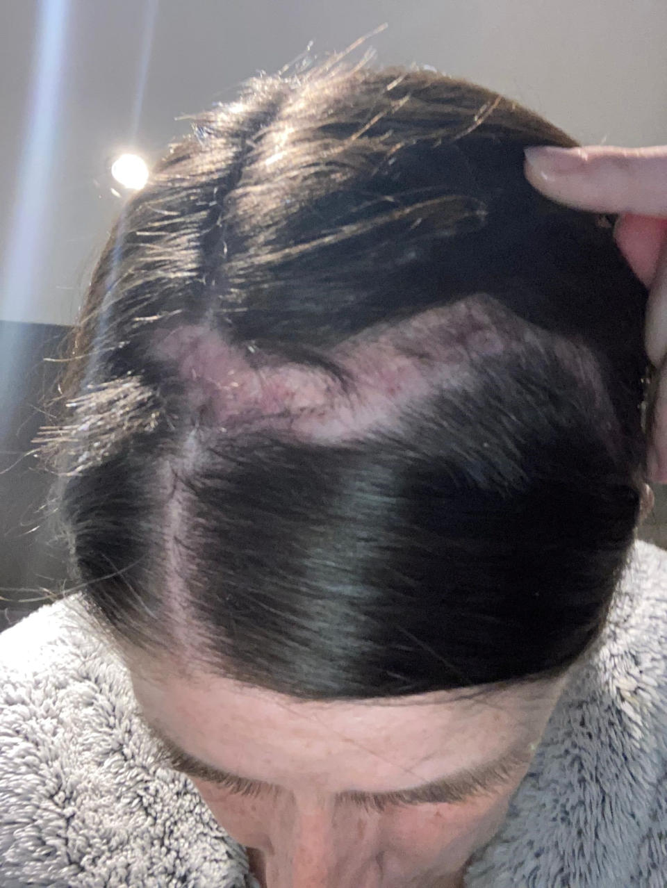 Kirsty Drury&#39;s scar one month after surgery. (SWNS)