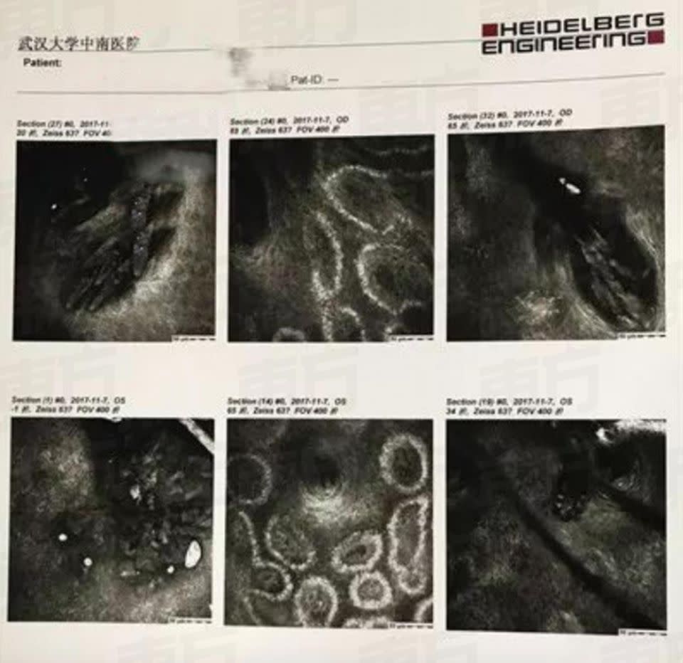 Doctors found 10 mites in one follicle. Photo: Australscope