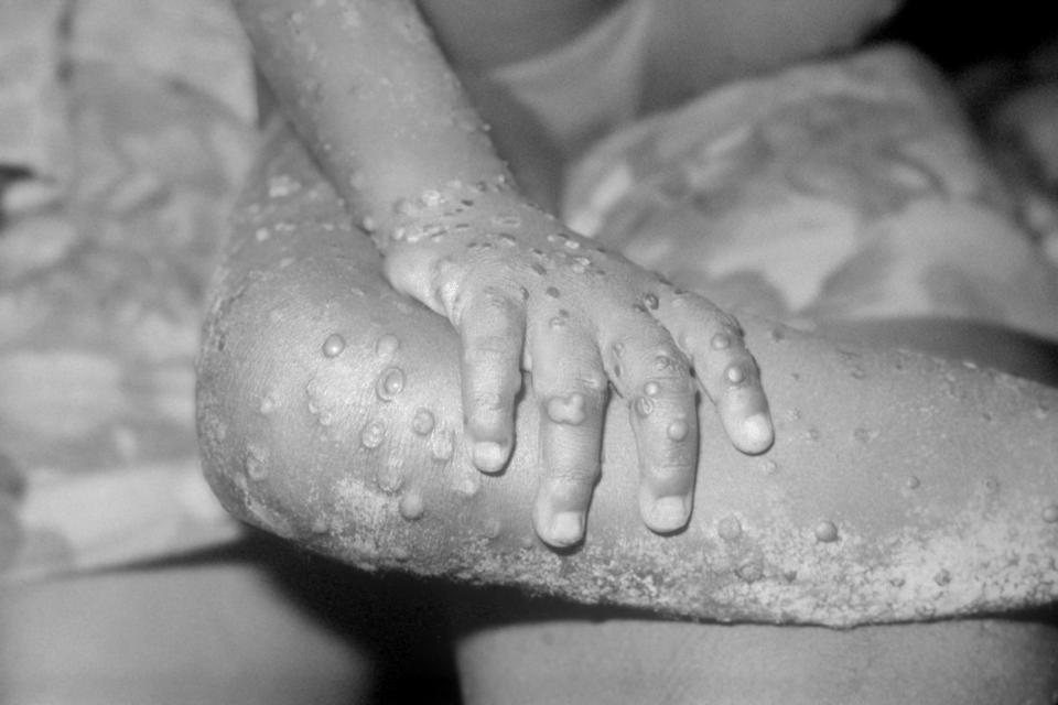 The legs and arms of a 4-year-old girl infected with monkeypox in Liberia.&nbsp; (Photo: BSIP via Getty Images)