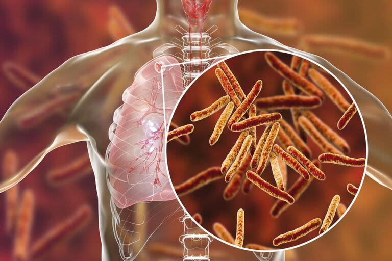 La tuberculosis está causada por el bacilo Mycobacterium tuberculosis y suele afectar a los pulmones