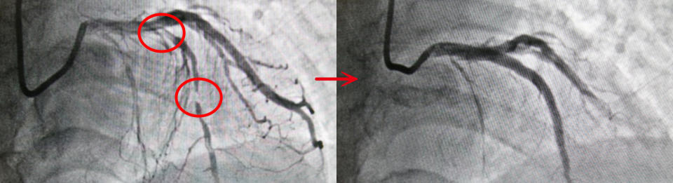 置放心血管支架之前，可以看見明顯血流受到血管阻塞影響(紅圈處)，置放支架之後，血流恢復正常。