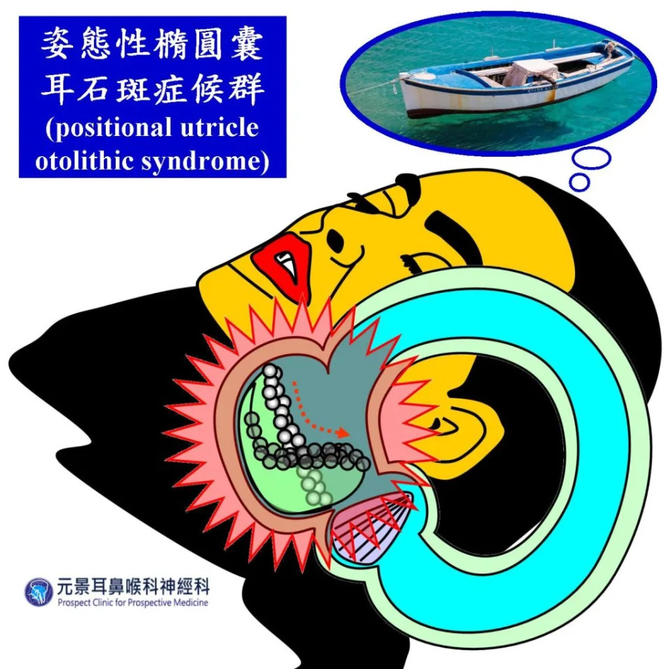 患者一躺下，耳石斑連同耳石膠從橢圓囊滑落，因重力因素流到低處，刺激底下纖毛，患者以為身體搖晃如搭船。（醫師陳建志提供）