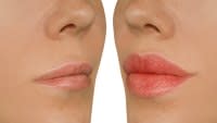plump-lips-before-after