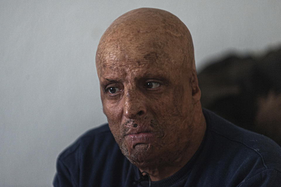 Hosni Kalaia, 49, talks in his house in Kasserine, Tunisia, Friday, Dec. 11, 2020. He's among hundreds of Tunisians who have turned to the desperate act of self-immolation as a form of protest in the past 10 years, following the example of Mohammed Bouazizi, a 26-year-old fruit seller who set himself ablaze on Dec. 17, 2010, to protest police harassment. (AP Photo/Riadh Dridi)