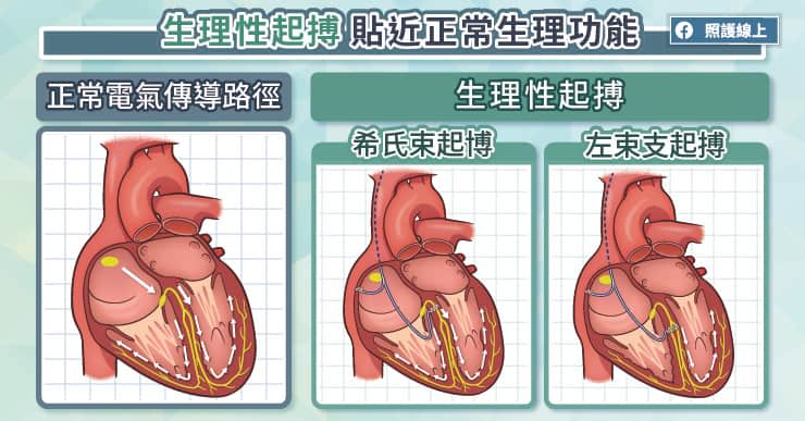 生理性起搏貼近正常生理功能