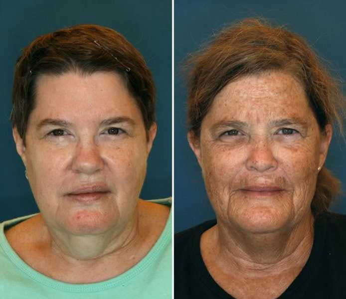 珍妮（左）和蘇珊（右）都是61歲，但皮膚狀況差很多。（圖／翻攝自Reddit）