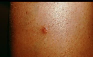 Photo credit: American Academy of Dermatology