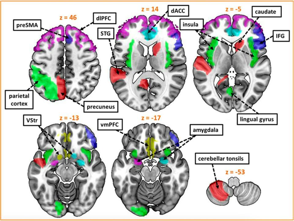 Revisión sistemática de alteraciones en la conectividad funcional del TCSC. PreSMA: Área motora suplementaria; VStr: Estriado Ventral; vmPFC: Córtex prefrontal ventral-medial; IFG: Giro frontal inferior; dACC: Córtex cingulado dorsal anterior; STG: Giro temporal superior; dlPFC: Córtex prefrontal dorso-lateral.