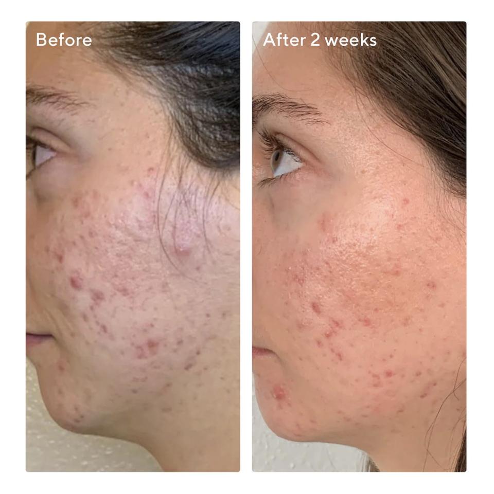 Side-by-side comparison of a person's skin before and after 2 weeks of treatment, showing improvement