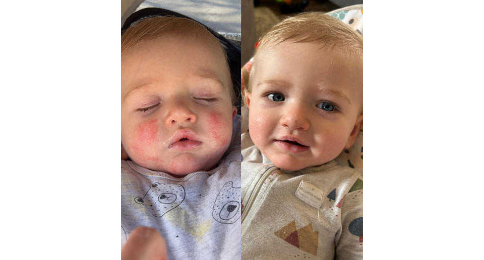 Before and after photos of child with eczema, and with cleared up skin