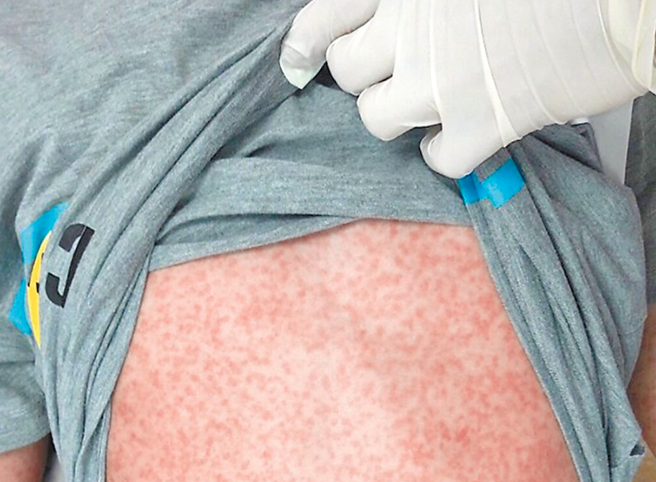 國內爆發今年首例本土麻疹病例！新北市36歲男性日前因持續發燒，4天內2度就醫，確診麻疹，緊急隔離，目前感染源不明。圖為麻疹症狀。（資料照片）
