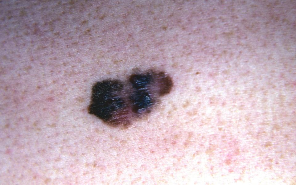 Nodular melanoma: tends to look like a bump or flat lesion which rises above the skin’s surface and is firm to the touch.