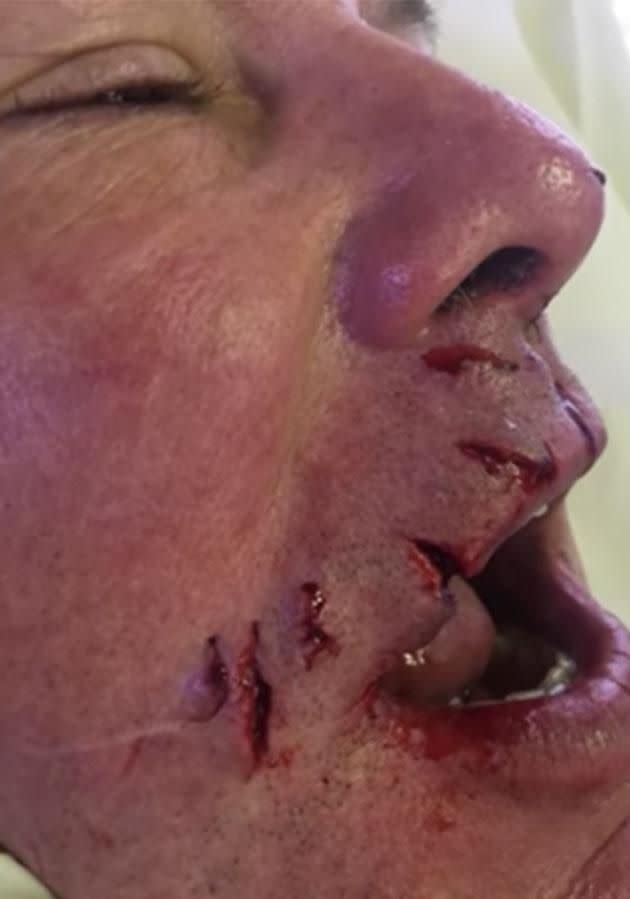 The aftermath of the face bite. Photo: YouTube