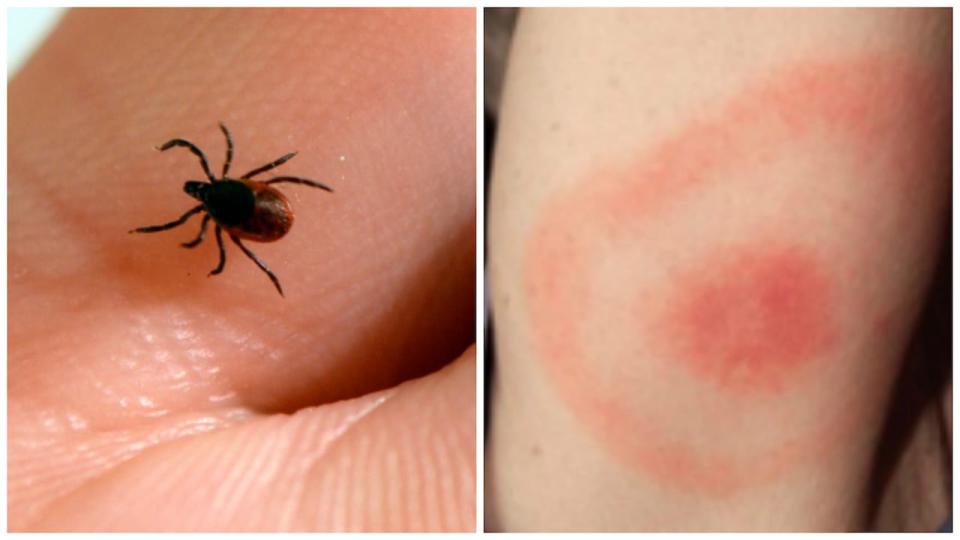 The Sudbury and District Health Unit says not all ticks carry Lyme disease, but it's a good idea to get checked out if you've been bitten.