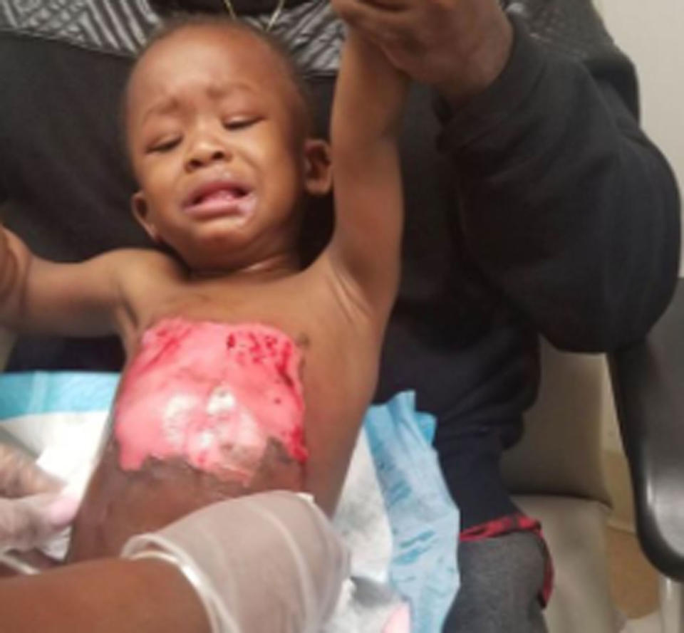 Cadien Scott Gaffney, a 17-month-old, has been left with burns after he was scalded by a cup of hot water at an Applebee’s restaurant in New York. Source: Twitter/ Eric Sanders