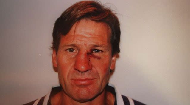 Sam Newman's broken nose. Source: Supplied