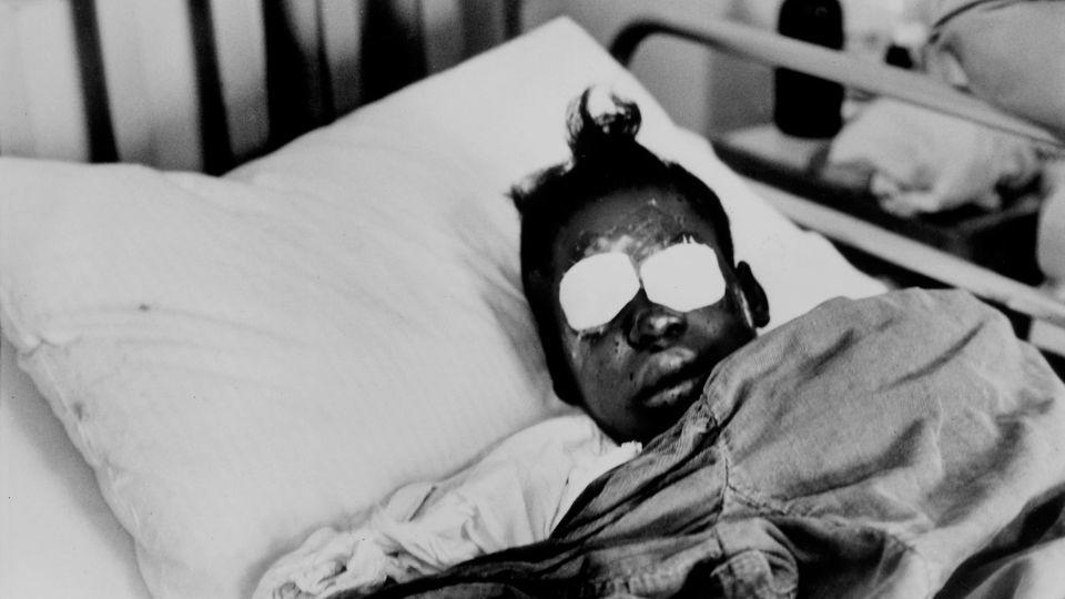 Hospitalized bomb blast victim, Sarah Jean Collins, 12,  blinded by dynamite explosion set off in basement of church that killed her sister and three other girls as her Sunday school class was ending. - Frank Dandridge/The LIFE Picture Collection/Shutterstock