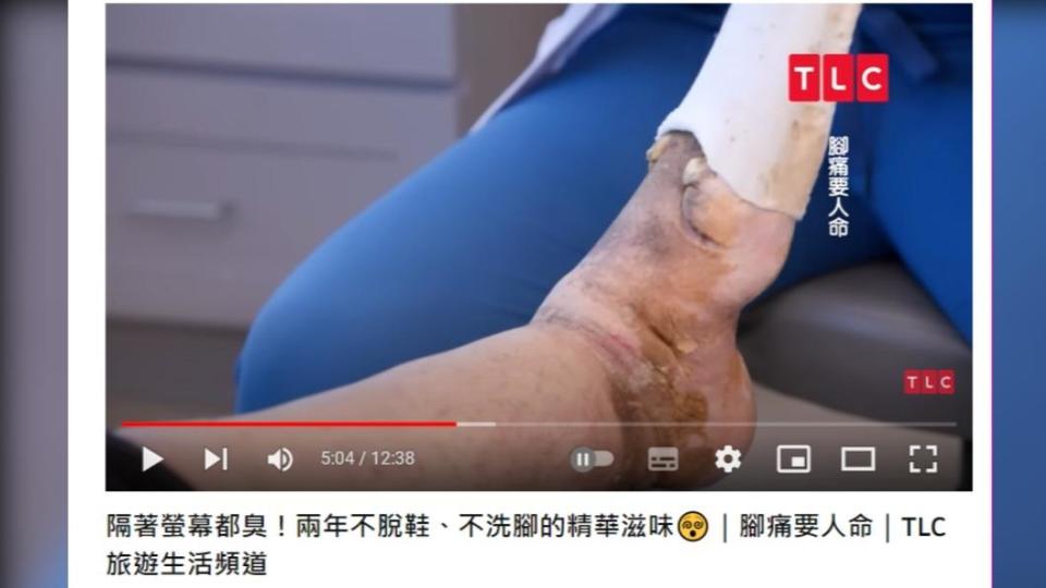 當懷諾娜的左腳重見光明時，診間開始瀰漫惡臭。（圖／翻攝自TLC 旅遊生活頻道YouTube）