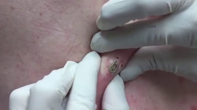 Dr. Pimple Popper See The Biggest Blackhead Ever Out Of Back