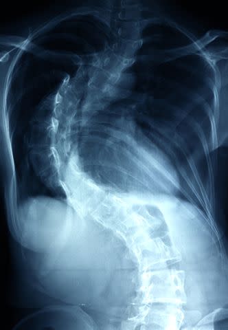 <p>NI QIN/E+ / Getty Images</p> X Ray of dextroscoliosos on top and levoscoliosis on the bottom.