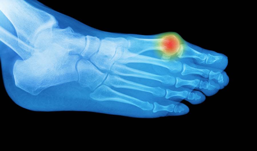 The Truth About Bunions, the Foot Problem Everyone's Embarrassed to Talk About 