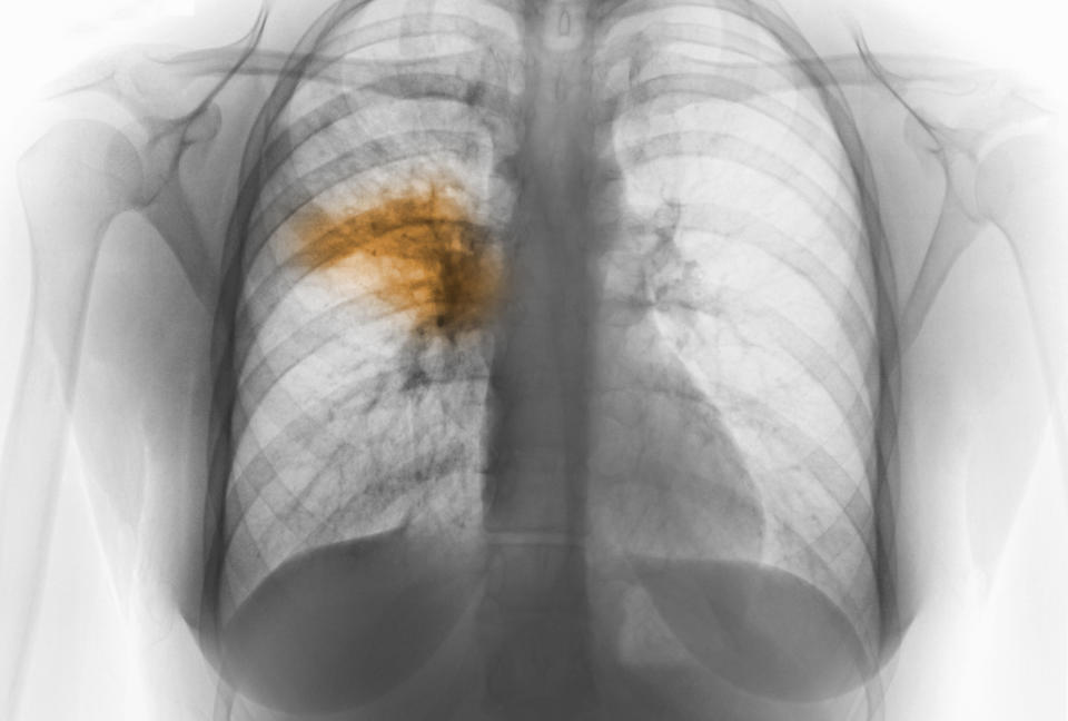 Radiografía de tórax que muestra neumonía. (Foto: Getty)