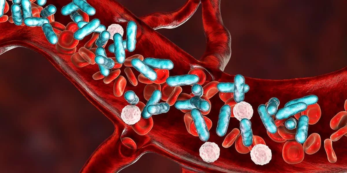 Infografía artística de sepsis en una infección | NPR/Kateryna Kon/Science Source 