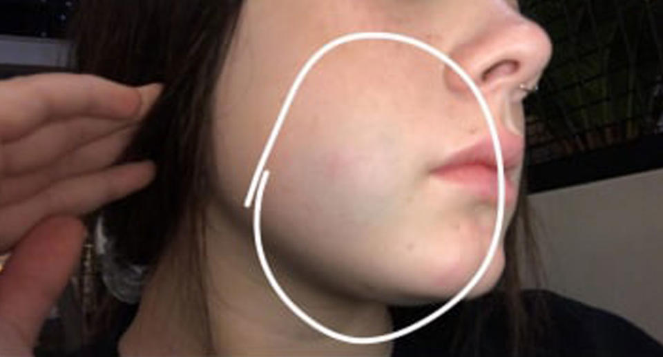 A bruise allegedly sustained when Tayla was punched two days prior to her mother. Source: Supplied