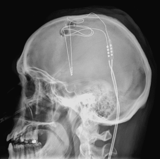 The team a West Virginia University implanted a Medtronic deep brain stimulation device in the addiction and reward center of the brain.