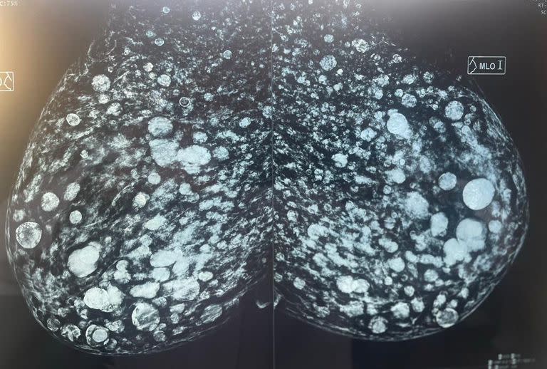 Así se ve una complicación (granulomas) de un aumento mamario por el uso de silicona industrial, una sustancia tóxica para el organismo
