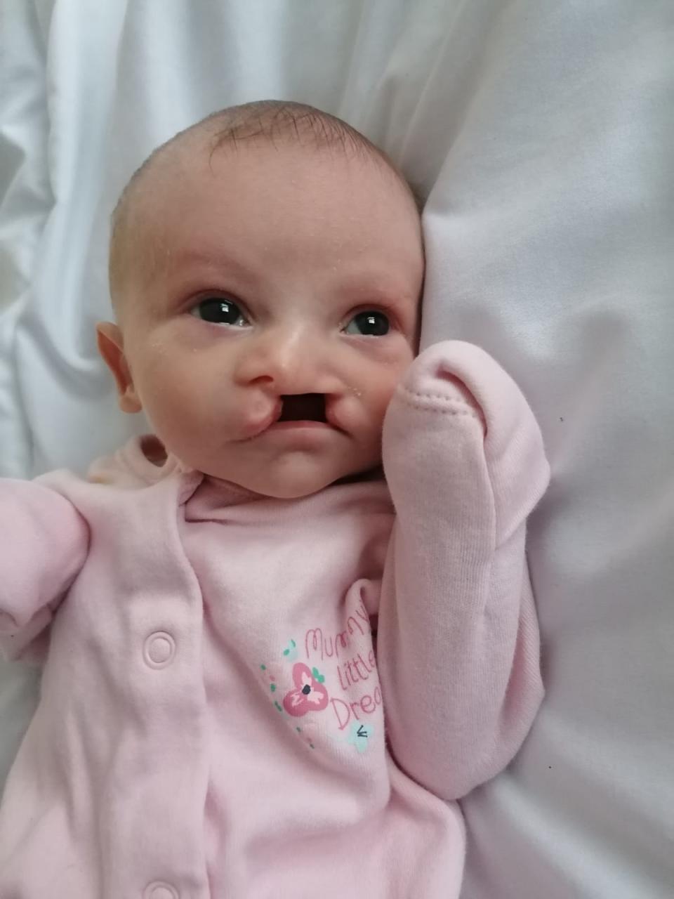 Felicity-May Harvey was born with a cleft lip. (SWNS)