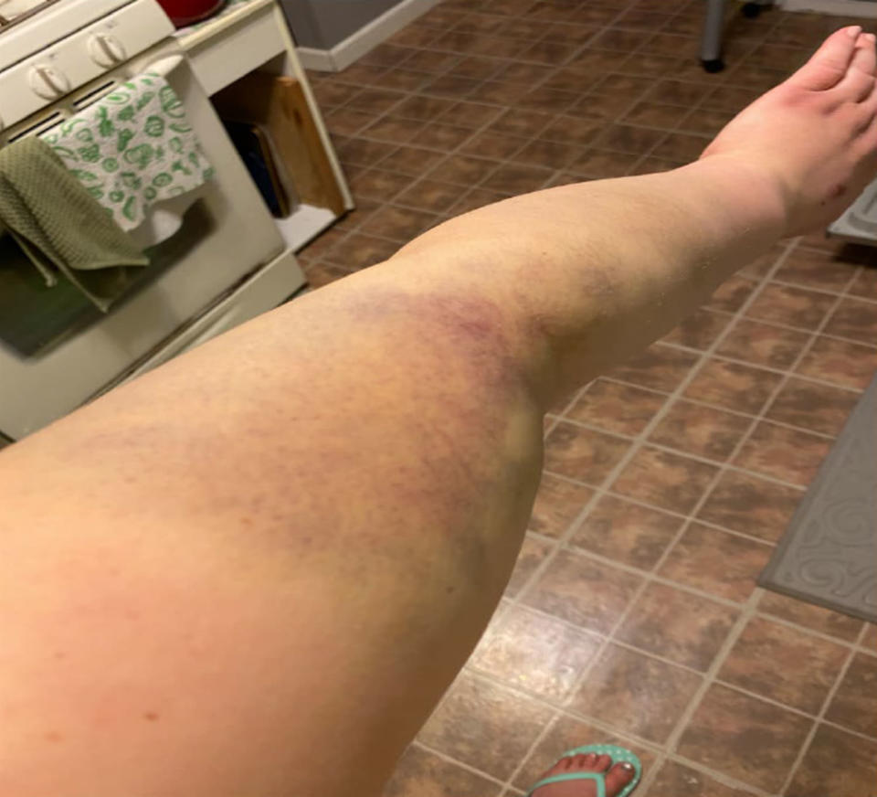 Bruising on Patty Day's arm (U.S. District Court)