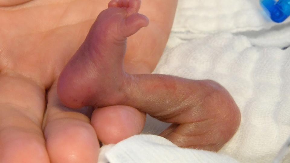 Frühchen in der Kinderklinik der Medizinischen Hochschule Hannover. Die Frühgeburtenrate liegt konstant zwischen sieben und neun Prozent.  Foto: Holger Hollemann/Archiv