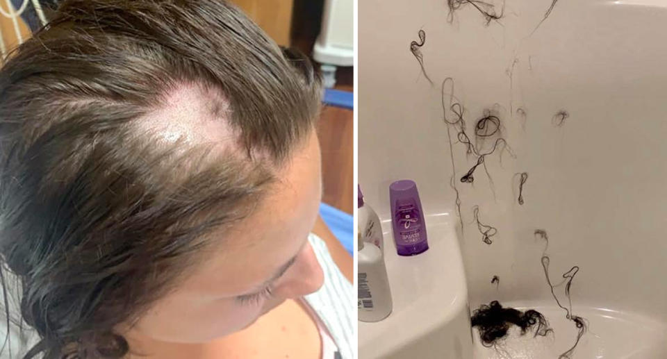 A split image showing Ashley Rose Robinson with a large bald patch on the top of her head, and Ms Robinson's shower with clumps of hair strewn on the walls and floor.