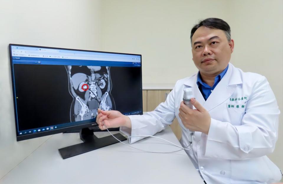 國泰綜合醫院泌尿科蔡樹衛醫師模擬以軟式輸尿管鏡治療腎結石。（國泰提供）