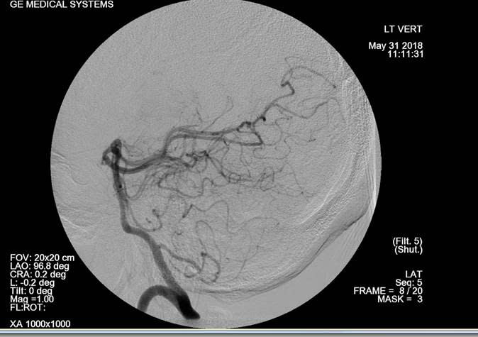 Williams' burst vein