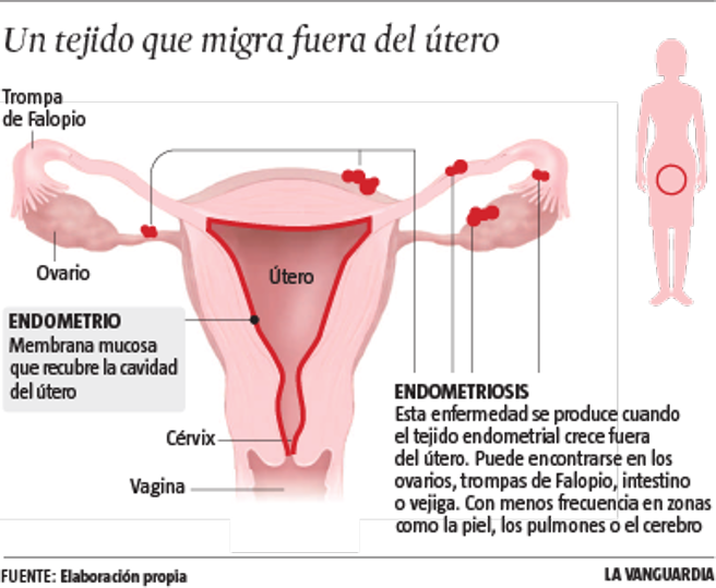 Endometriosis