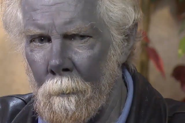 Man with completely blue skin dies at 62
