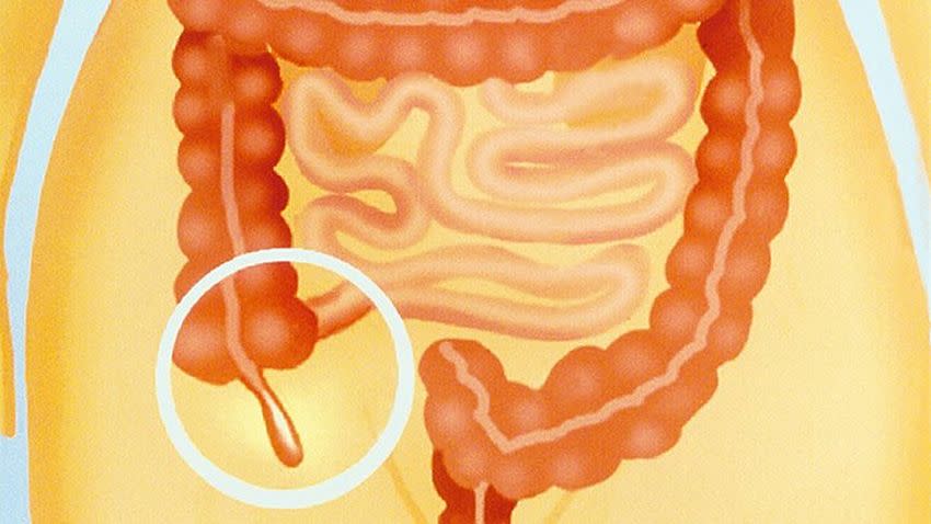 ¿Extirpar el apéndice aumenta o reduce el riesgo de Parkinson? Dos artículos recientes llegan a conclusiones contrarias